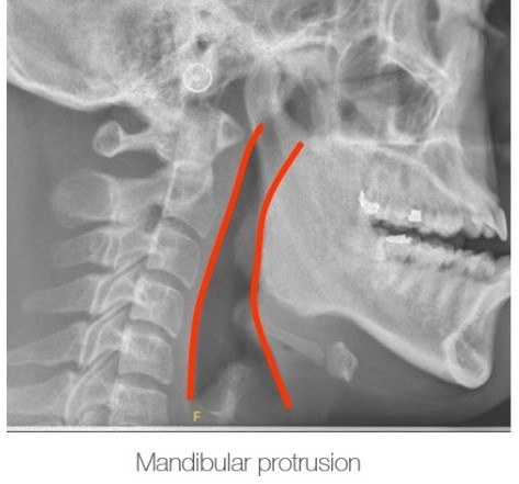 口內呼吸道影像